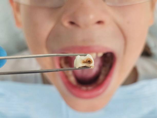 Best Emergency Dentist for Knocked-Out Tooth in Ogdensburg, NY